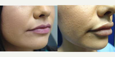 25-34 year old woman treated with Injectable Fillers - 28 year old female 1 year after two sessions of lip injections with Juvederm Ultra XC for a total of 2cc's. The injections were done to her upper and lower lips in the office using numbing creams. She guided her treatment and wanted very full lips.