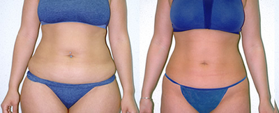 Woman treated with Liposuction - Woman treated with Liposuction
