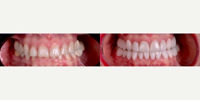 Woman treated with Porcelain Veneers - Transform Your Smile with Veneers! Swipe to see the difference that veneers can make! From discolored or misaligned teeth to a bright, even, and confident smile.