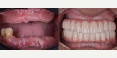 Woman treated with Dental Implants - What a great privilege, to change lives so that they can impact other people with their smile.All on 6 Top and bottom, Zirconia Overdenture.Full digital, facial scan and Intraoral scan.
