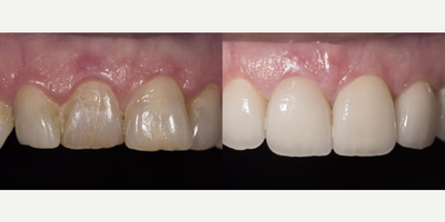 Porcelain veneers for old and discolored teeth - Porcelain veneers for old and discolored teeth