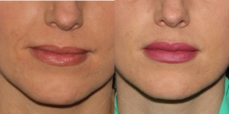 25-34 year old woman treated with Lip Augmentation - Young woman desiring improved fullness and shape of her lips.  Augmentation performed with local anesthetic block.  Restylane (hyaluronic acid)  filler used for the augmentation.
