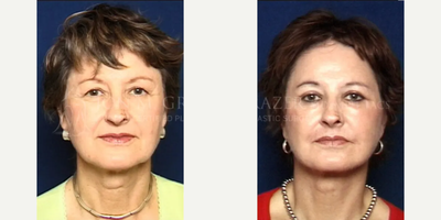 55-64 year old woman treated with Phenol Peel - 58 yo facelift, quad bleph, canthopexy, perioral phenol peel, dorsal nasal reconstruction. Pt had previous radiation therapy for skin cancer with resorption of the cartilagecorrection of neck thyroidectomy scar.