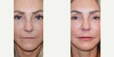 Lip Augmentation Before & After: Two Years Following Three Microdroplet Silikon-1000 Treatments - Our beautiful patient is seen before and two years following three permanent lip augmentation treatments with microdroplet Silikon-1000. She is an excellent candidate for permanent lip augmentation since she has congenitally small lips. When permanent soft tissue augmentation is necessary, Silikon-1000 offers precision, permanence, versatility, and safety, with a track record of over 50 years. Additionally, we feel that Silikon-1000 permanent lip augmentation leads to a much more natural-looking lip appearance compared to HA fillers, which can look overdone and unnatural in some people. Silikon-1000 is also a safer alternative to HA, as it never leads to necrosis, embolus, blindness, stroke, infection, or biofilm. Treatments are performed with topical anesthetic, and there is typically no downtime.