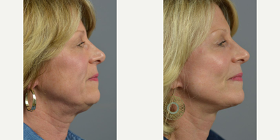 Woman treated with Eyelid Surgery - These results from a recent facelift, blepharoplasty with fat repositioning case performed by facial specialists, Dr. James C. Marotta.