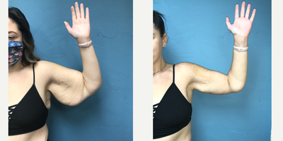 25-34 year old woman treated with Arm Lift - Patient had an Arm Lift also known as Brachioplasty