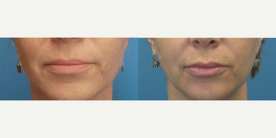 56 year old woman treated with Restylane Silk - This patient's lips had lost volume with aging, she desired a subtle enhancement