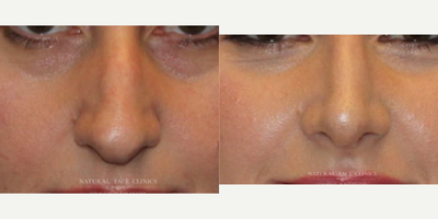 35-44 year old woman treated with Rhinoplasty - Patient suffered from crooked nasal tip, dorsal hump, droopy nasal tip