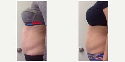 35-44 year old woman treated with UltraShape Power - 90 days post 3 treatments