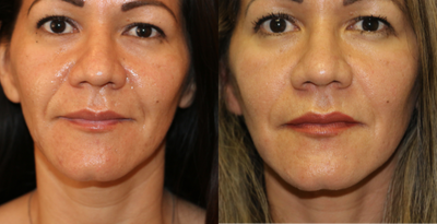 45-54 year old woman treated with Juvederm - This 48-year-old female has just had one cc of Juvderm ultra plus injected into each of her nasal labial folds, otherwise known as a laugh lines.