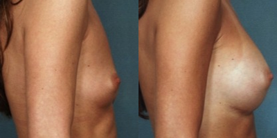 35-44 year old woman treated with Breast Augmentation - Age: 40
Height: 5'6
Weight: 125 lbs.
Implant Type: Natrelle Silicone Moderate Plus Profile
Implant Size: 339 cc
This woman lost breast volume after children. She wanted to return to her previous size and feel more comfortable in a bra and a bikini. Dr. Bucky utilized style 15 339cc moderate profile silicone gel breast implants in a submuscular position.