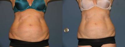 Exilis body - 
	Exilis on upper and lower abdomen
