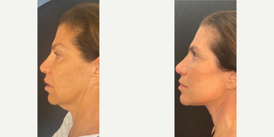 Woman treated with Neck Lift - Woman treated with Neck Lift to improve turkey neck as well asDeep PlaneFacelift to lift jowls, cheeks, and jawline.
