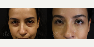 25-34 year old woman treated with Injectable Fillers - 25-34 year old man treated with Injectable Fillers using1cc Teosyal Redensity 2injected to under eye region