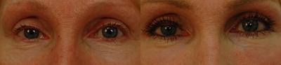 45-54 year old woman treated with ProFractional Laser - Laser Resurfacing for eye rejuvenation with the Sciton Profractional laser after one treatment.