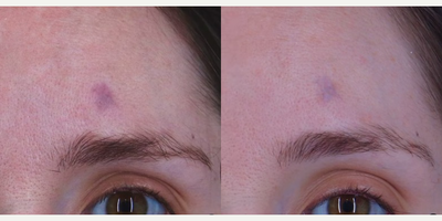 Woman treated with Laser Scar Removal - After just one treatment, our patient is already experiencing remarkable improvements in her scars texture and appearance. The scar will improve even more after another treatment. Our vascular laser targets the redness in your skin, helping to improve the appearance of those troublesome scars. We create a treatment plan that is tailored to your skins specific needs to achieve the best possible results.