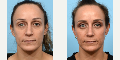 35-44 year old woman treated with Eyelid Surgery, Double Eyelid Surgery - This 41-year-old patient came to Dr. Wise for an Upper and Lower Blepharoplasty to correct her heavy eyelids, and dark under-eye circles. 2 months after her procedure, she loves how revitalized she now looks.