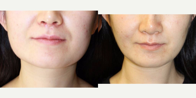 18-24 year old woman treated with Jaw Reduction - Jaw Reduction
