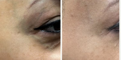 45-54 year old woman treated with Excel V - 45-54 year old woman treated with Excel V