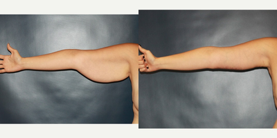 Arm Lift - Brachioplasty