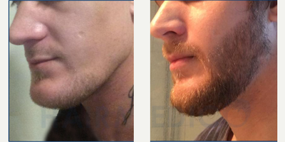 35-44 year old man treated with Beard Transplant - Beard TransplantFUE Techniqueincisions performed by using the sapphire technique.2800 grafts transplanted.