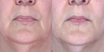 55-64 year old woman treated with ArteFill - 62 year old female received ArteFill to nasolabial folds and marionette lines