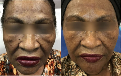 65-74 year old woman treated with Laser Treatment - Treated with Pico Focus laser and PRP injections. This is our Pico Vampire Facial treatment. We can treat all skin types with almost no down time.