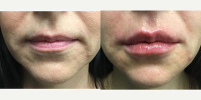 35-44 year old woman treated with Lip Augmentation - Lip Augmentation with filler - 1cc of Juvederm Ultra Plus