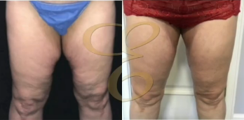 Woman treated with Vaser Liposuction - Woman treated with Vaser Liposuction