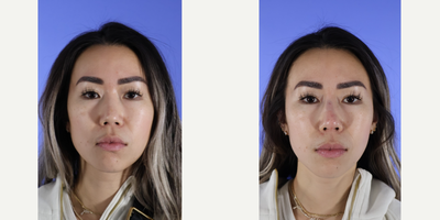 35-44 year old woman treated with Nonsurgical Nose Job, Restylane Lyft - Patient consulted about a Liquid Rhinoplasty. Patient wanted a more defined tip and didn't like how flat her nose was. We were able to elevate her bridge and give her a defined tip with one syringe of Restylane Lyft.