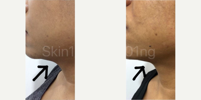 Woman treated with Mesotherapy - Woman treated with Mesotherapy.
