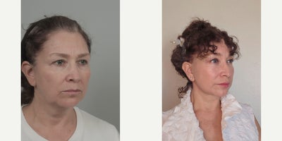 55-64 year old woman treated with AccuLift, Facelift, Lip Fillers, SMAS Facelift - .