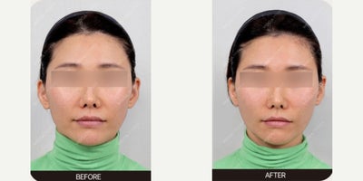 Juvelook Volume for Midface Rejuvenation and Natural Facial Fullness - This patient underwent Juvelook Volume treatment to address mild volume loss and improve overall facial contours. The treatment focused on restoring soft tissue support in the midface while stimulating collagen production for gradual, natural-looking improvement.