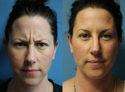 Woman treated with Dysport - Woman treated with Dysport