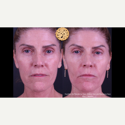 45-54 year old woman treated with FaceTite, Eyelid Surgery - Facetite, Fat Transfer to Face, Erbium Face and Exosomes Face After 2 Months
