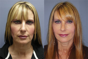 Lower face Lift - 
	Lower Face Lift
