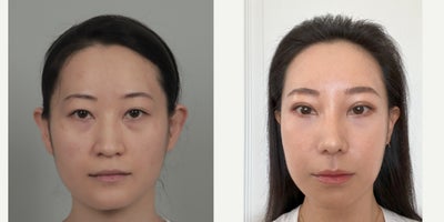 35-44 year old woman treated with Cheekbone Reduction, Double Eyelid Surgery, Eyelid Surgery, Facial Fat Transfer, Mini Facelift - .