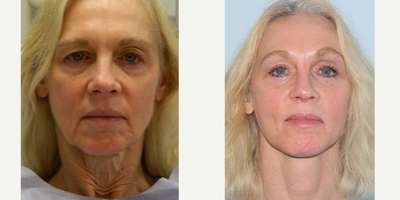 55-64 year old woman treated with Mini Lift, 4-Lid Blepharoplasty and Browlift - 57 year old woman treated with Mini Lift, 4-Lid Blepharoplasty and Browlift.