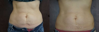 Exilis Treatment For Stomach Tightening  - The after photo is after 5 Exilis treatments.