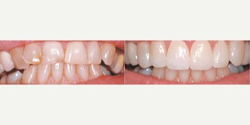 25-34 year old woman treated with Braces - Misalignment Treatment with Braces