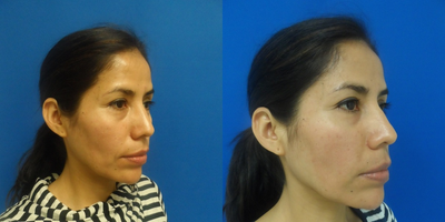 Case #restylane and fillers patient - Injected 0.5 cc restylane into each infraorbital area, and one cc in each nasolabial fold to achieve a younger and more rested appearance in a restylane patient.