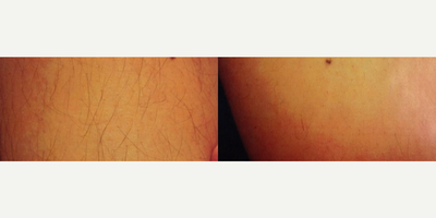 32 year old patient treated with Laser Hair Removal - 32 year old patient treated with Laser Hair Removal