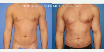 Man treated with Bicep Implants - Man treated with Bicep Implants