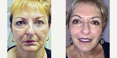 65-74 year old woman treated with Dermapen - Patient had upprrlid blepharoplasty, microneedling , pelleve and Juvederm.