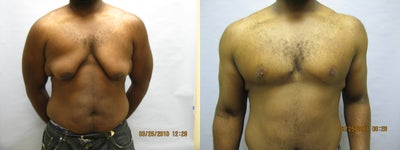 34 y.o man with breast reduction - 
	This gentleman required a mastectomy technique with nipple grafts to obtain good contour. The nipple color improves with time.
