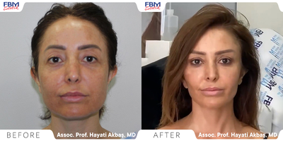 35-44 year old woman treated with Mini Facelift, Brow Lift, Facial Fat Transfer - This patient requested a small lifting and to obtain a slim tightened face, she was treated with a mini face lift and brow lift.