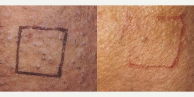 Woman treated with Laser Hair Removal - Woman treated with Laser Hair Removal