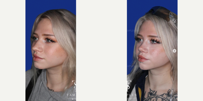 Woman treated with Rhinoplasty - Beautiful results 3 months after a finesse Rhinoplasty. This patient didnt like her previously boxy tip and wanted a smaller, more refined nose but didnt need major changes.I did an open Rhinoplasty, supported and refined her nasal tip giving her the feminine profile shes always wanted. She loves her new nose and so do we!