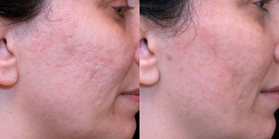 35-44 year old woman treated with Pulsed Dye Laser, Bellafill, Fraxel Laser - This patient presented for acne treatment. Following a series of photo dynamic therapy treatments, once active acne was the patient was treated with a series of vascular laser treatments to improve redness, Fraxel 1550nm laser and Bellafill semi-permanent filler to improve scars.