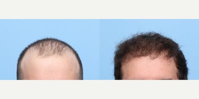 18-24 year old man treated with Hair Transplant, Hair Loss Treatment, PRP for Hair Loss, FUE Hair Transplant - At 20 years old, this patient wanted a permanent solution to his early balding. Dr. Wise performed an FUE hair transplant, placing 4,350 grafts to the front of the scalp and also performed one session of PRP therapy.